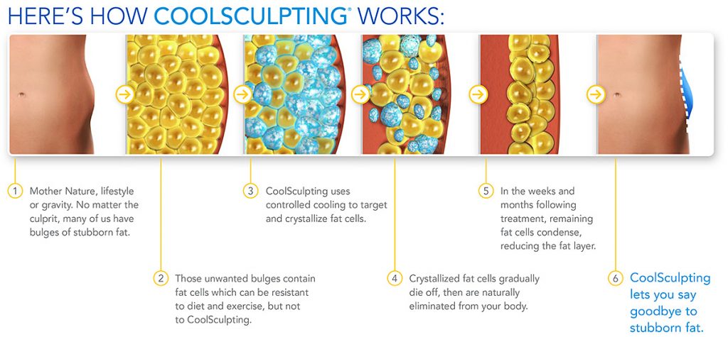 Glo Antiaging Calgary and Kelowna coolsculpting