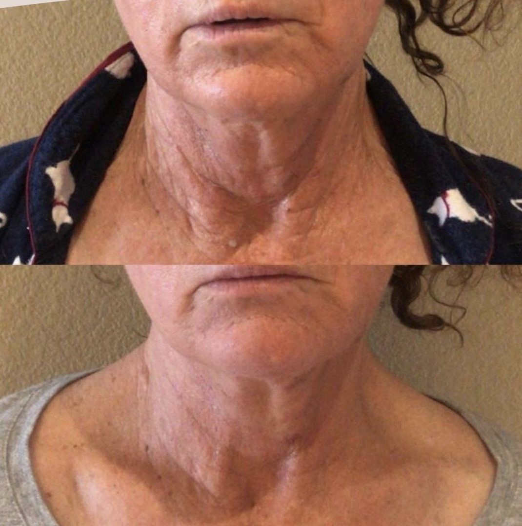 Sylfirm X Radio Frequency Microneedling Glo Antiaging Calgary and Kelowna Before and After