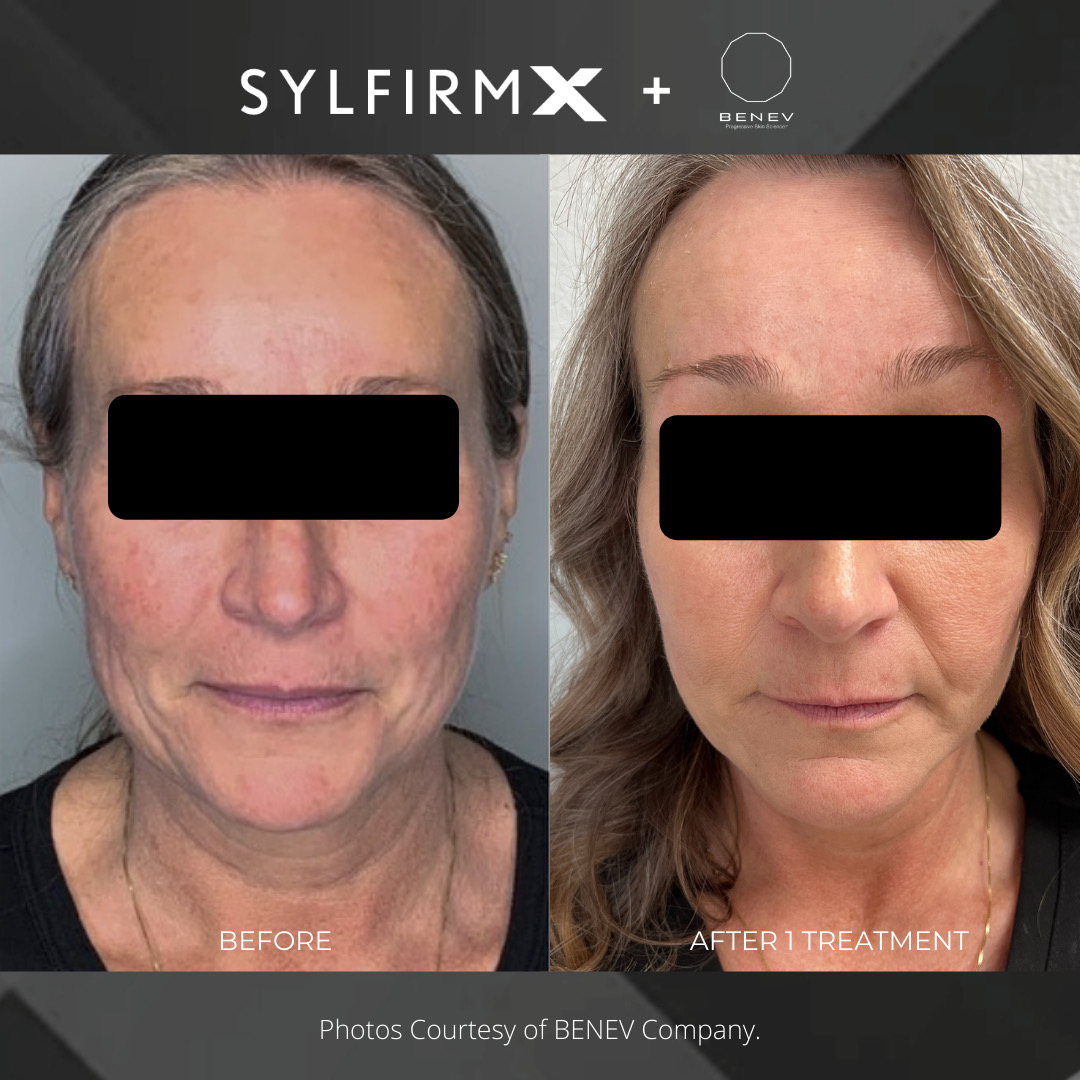 Sylfirm X Radio Frequency Microneedling Glo Antiaging Calgary and Kelowna Before and After