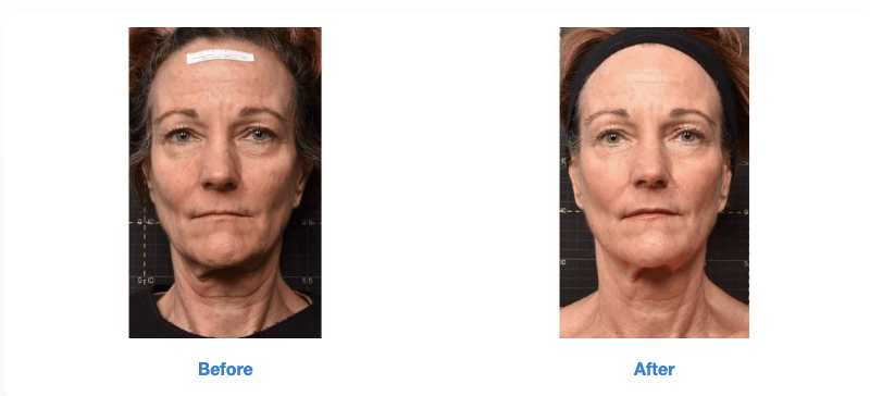 Sofwave™ at GLO Antiaging Before and After full face