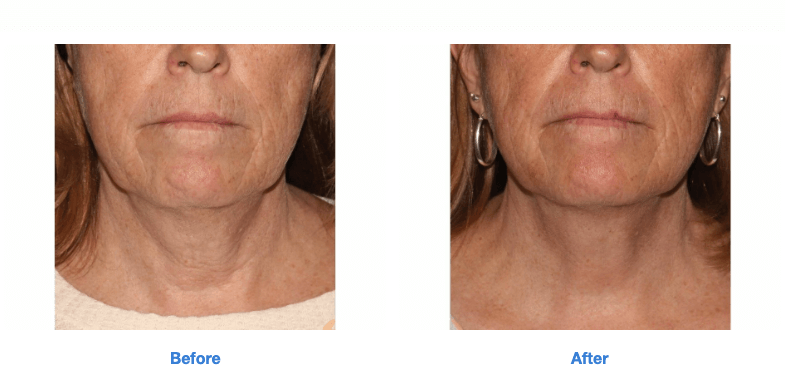 Sofwave™ at GLO Antiaging Before and After lower face