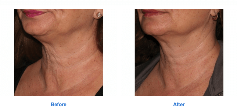 Sofwave™ at GLO Antiaging Before and After lower jawline and neck